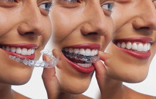Getting Invisalign at Westwood NJ