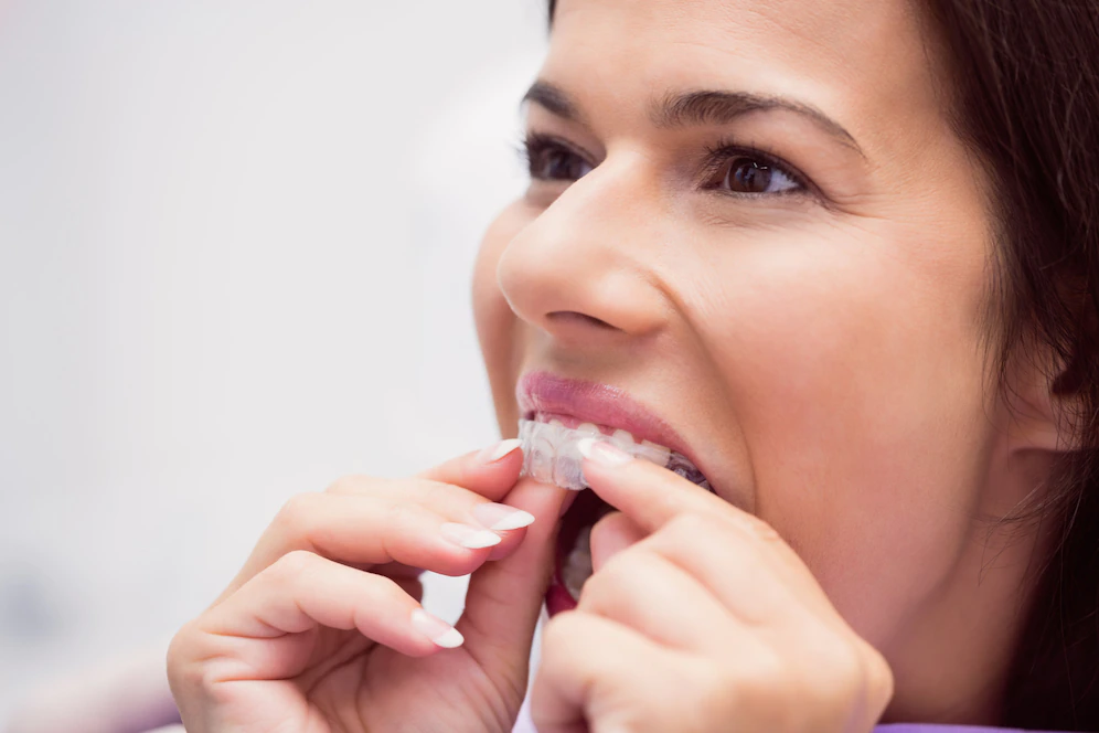 What are the Advantages of Invisalign - Milestone