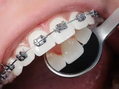 Braces Saddle Brook