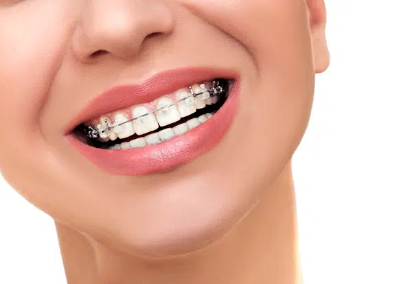 Different Parts of Braces