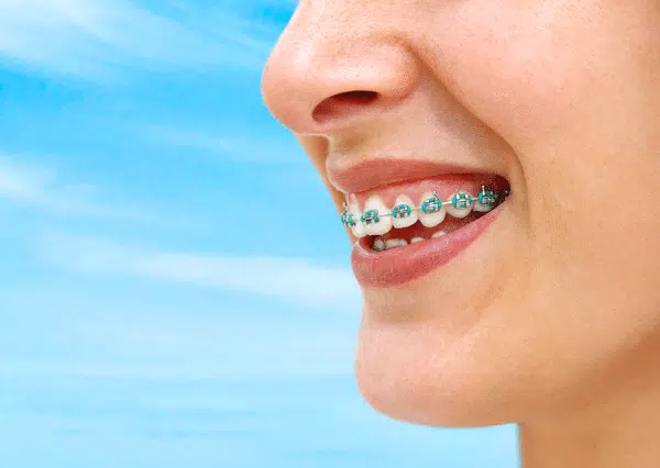 braces near ridgewood nj