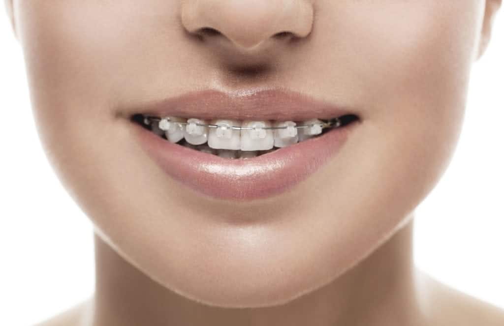 What are Ceramic Braces?