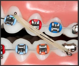 paramus-orthdontist-braces