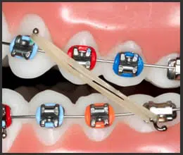 paramus-orthdontist-braces