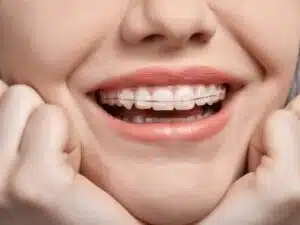 Types of Braces and Cost